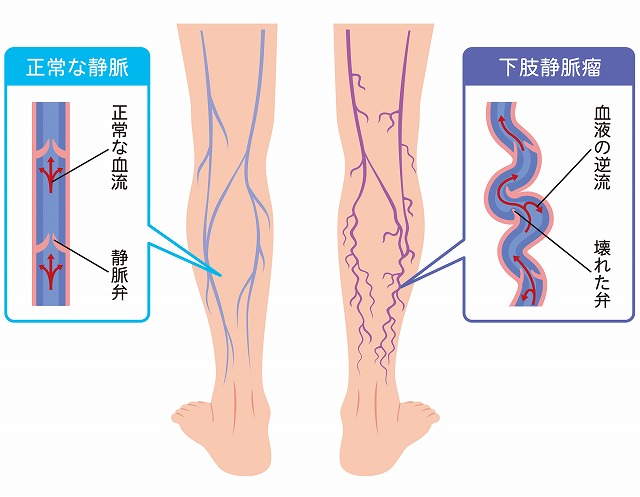 下肢静脈瘤とは
