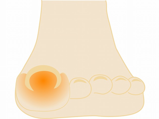 巻き爪・陥入爪とは？
